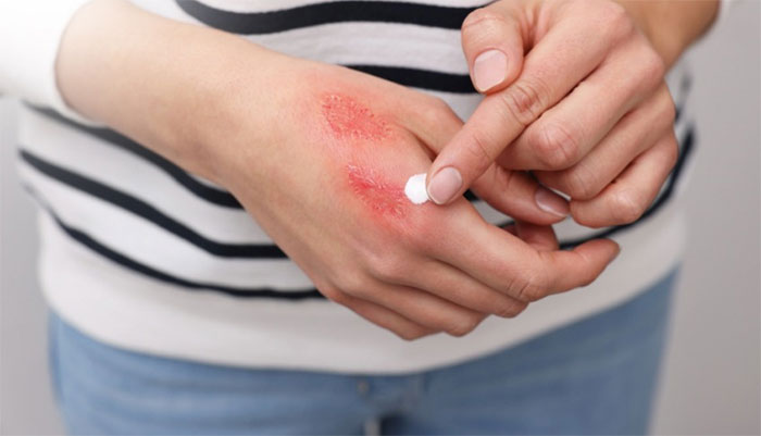 boi-kem-oxit Người bị kiến ba khoang đốt nên bôi kẽm oxit để giảm nhẹ triệu chứng