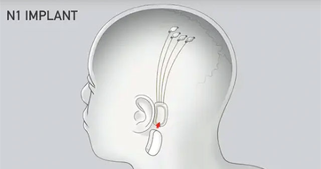 Khám Phá Cuộc Cách Mạng Cấy Chip Não Của Neuralink