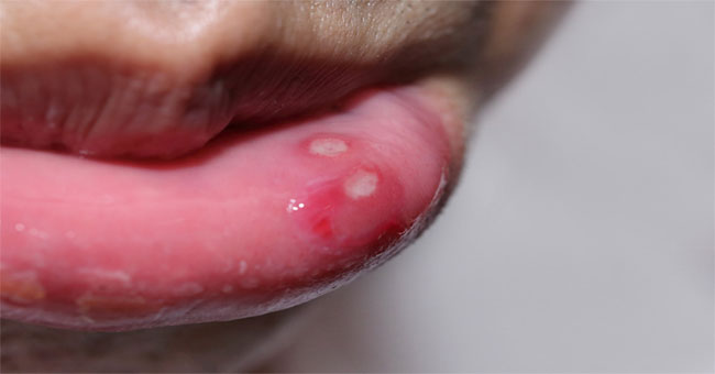 Khám Phá Nhiệt Miệng: Nguyên Nhân, Triệu Chứng và Phương Pháp Điều Trị