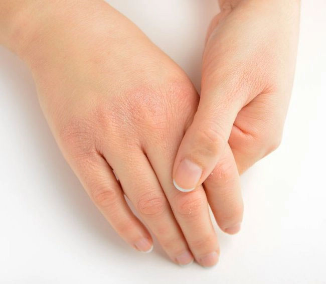 Da bị dày và sần sùi