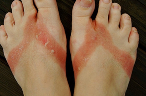 Nổi mụn nước khi đi dép tông