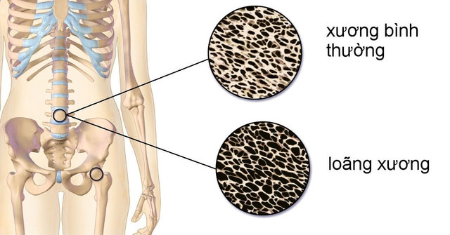4 Loại Thực Phẩm Nên Tránh Để Bảo Vệ Canxi Cho Cơ Thể