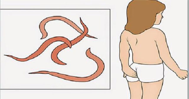 Bắt giun kim cho trẻ: hướng dẫn an toàn và các phương pháp tại nhà